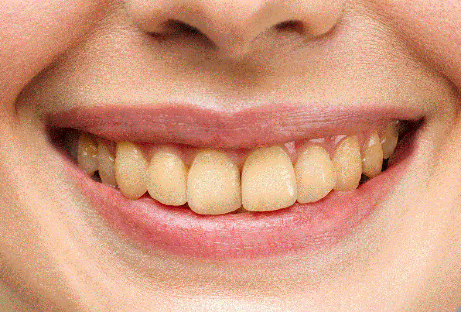 dientes-apolonia-antes-chica